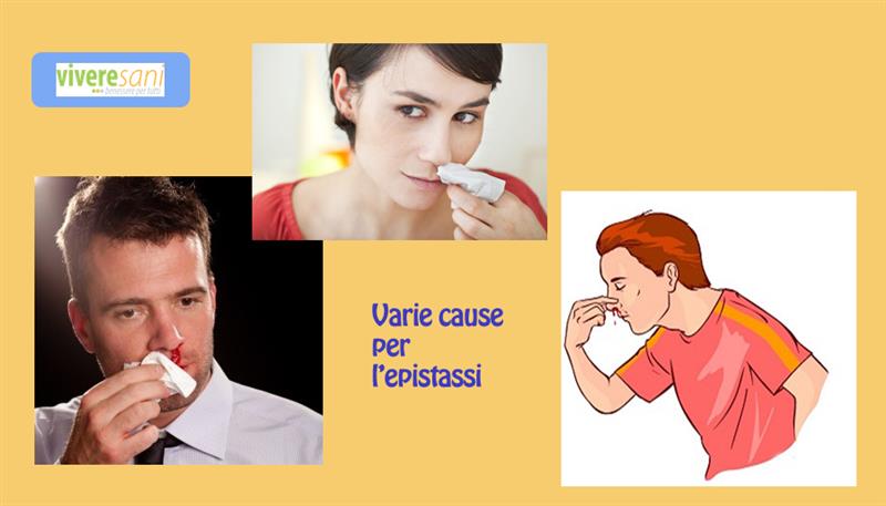 Epistassi o sangue dal naso Epistassi o sangue dal naso